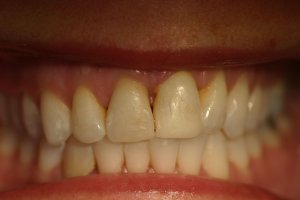 Photo of smile before cosmetic dental treatment