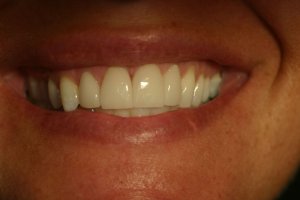 Photo of smile after cosmetic dental treatment