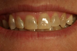 Photo of smile before veneers