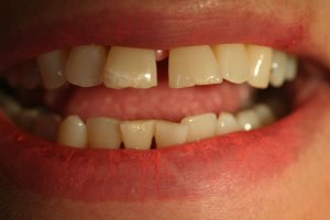 Photo of smile before veneers