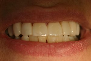 Photo of smile after veneers