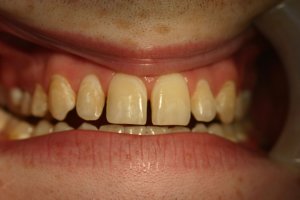 Photo of smile before veneers