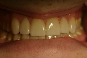 Photo of smile after veneers