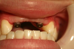 Photo of smile before dental reconstruction