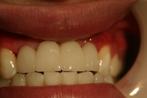 Photo of smile after dental reconstruction