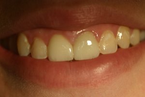 Photo of smile before cosmetic dental treatment