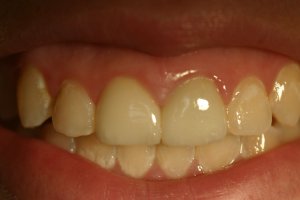 Photo of smile after cosmetic dental treatment