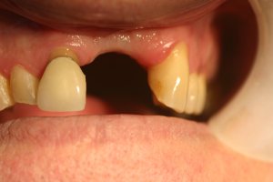 Photo of smile before dental bridge