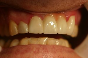 Photo of smile after dental bridge