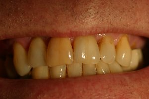 Photo of smile before veneers