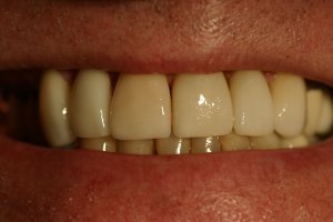 Photo of smile after veneers