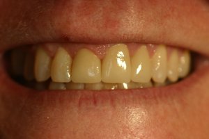Photo of smile after cosmetic dental treatment