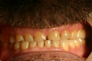 Photo of smile before dental reconstruction