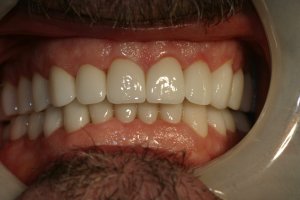 Photo of smile after dental reconstruction