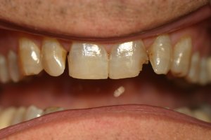 Photo of smile before dental crowns