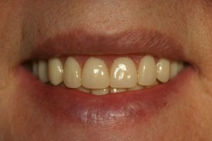 Photo of smile after dentures