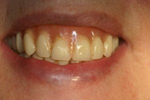 Photo of smile before dentures