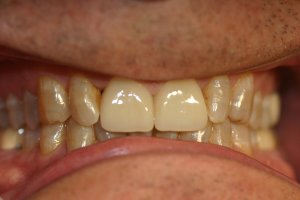Photo of smile after dental crowns